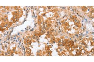 Immunohistochemistry of paraffin-embedded Human thyroid cancer using CRELD2 Polyclonal Antibody at dilution of 1:50 (CRELD2 anticorps)