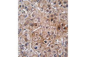 Formalin-fixed and paraffin-embedded human hepatocarcinoma tissue reacted with BMPR2 antibody (N-term), which was peroxidase-conjugated to the secondary antibody, followed by DAB staining.