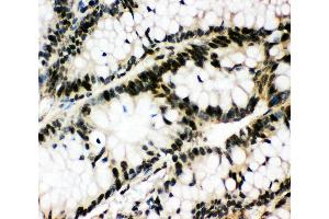 Anti-Egr1 antibody, IHC(P) IHC(P): Human Intestinal Cancer Tissue (EGR1 anticorps  (N-Term))