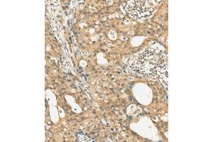 (ABIN392009 and ABIN2837977) staining c-KIT in human breast carcinoma tissue sections by Immunohistochemistry (IHC-P - paraformaldehyde-fixed, paraffin-embedded sections). (KIT anticorps  (AA 912-941))