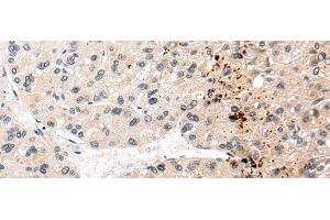 Immunohistochemistry of paraffin-embedded Human liver cancer tissue using AQP11 Polyclonal Antibody at dilution 1:30 (AQP11 anticorps)