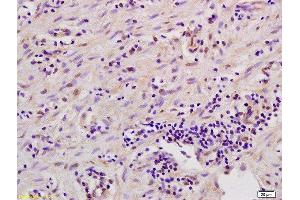Formalin-fixed and paraffin embedded human gastric carcinoma labeled with Anti-MSK1/RPS6KA5 Polyclonal Antibody, Unconjugated  at 1:200 followed by conjugation to the secondary antibody and DAB staining. (Msk1/2 (AA 49-94) anticorps)
