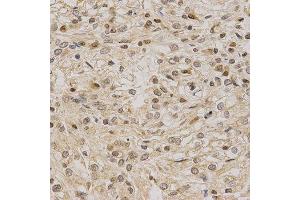 Immunohistochemistry of paraffin-embedded human kidney cancer using LETMD1 antibody at dilution of 1:200 (x40 lens) (LETMD1 anticorps)