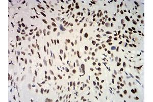 Immunohistochemical analysis of paraffin-embedded esophageal cancer tissues using ESR1 mouse mAb with DAB staining.