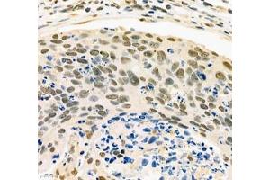 Immunohistochemistry of paraffin embedded human cervical cancer using PABPN1 (ABIN7075116) at dilution of 1:600 (400x lens) (PABPN1 anticorps)