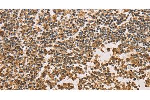 Immunohistochemistry of paraffin-embedded Human tonsil tissue using SETD2 Polyclonal Antibody at dilution 1:40 (SETD2 anticorps)