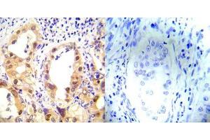 Immunohistochemical analysis of paraffin-embedded human lung carcinoma tissue using P53 (phospho-Ser37) antibody (E012031). (p53 anticorps  (pSer37))