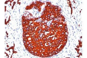 Formalin-fixed, paraffin-embedded human Breast Carcinoma stained with Cytokeratin, pan Monoclonal Antibody cocktail (KRTL/1077 + KRTH/1076). (KRT77, KRT76 anticorps)