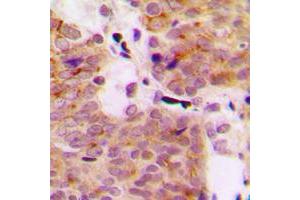 Immunohistochemical analysis of MEKK1 (pT1402) staining in human breast cancer formalin fixed paraffin embedded tissue section.