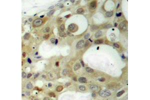 Immunohistochemistry of paraffin-embedded human breast carcinoma using Phospho-AR-S650 antibody (ABIN2987884). (Androgen Receptor anticorps  (pSer650))