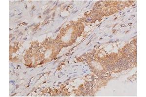 ABIN6269133 at 1/200 staining Human colon cancer tissue sections by IHC-P. (KIT anticorps  (Internal Region))