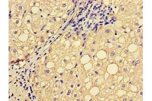 Immunohistochemistry of paraffin-embedded human liver cancer using ABIN7151827 at dilution of 1:100 (EPHA1 anticorps  (AA 296-414))