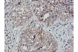 Immunohistochemical staining of paraffin-embedded Adenocarcinoma of Human ovary tissue using anti-PDSS2 mouse monoclonal antibody. (PDSS2 anticorps)