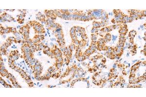 Immunohistochemistry of paraffin-embedded Human thyroid cancer using ATPIF1 Polyclonal Antibody at dilution of 1:50