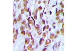 Immunohistochemical analysis of PHF19 staining in human ovarian cancer formalin fixed paraffin embedded tissue section.