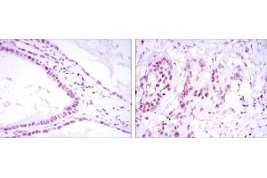 Immunohistochemical analysis of paraffin-embedded kidney convoluted tubule tissues (left) and esophageal cancer tissues (right) using SUZ12 mouse mAb with DAB staining. (SUZ12 anticorps)