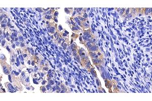 Detection of MMP7 in Human Endometrial cancer Tissue using Polyclonal Antibody to Matrix Metalloproteinase 7 (MMP7) (MMP7 anticorps  (AA 1-267))