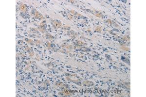 Immunohistochemistry of Human gastic cancer using PTAFR Polyclonal Antibody at dilution of 1:70 (PTAFR anticorps)