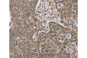 Immunohistochemistry of Human lung cancer using IL15RA Polyclonal Antibody at dilution of 1:45