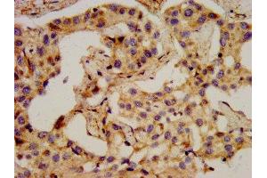 IHC image of ABIN7161261 diluted at 1:400 and staining in paraffin-embedded human liver cancer performed on a Leica BondTM system. (PCSK2 anticorps  (AA 267-391))