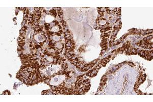 ABIN6267216 at 1/100 staining Human thyroid cancer tissue by IHC-P.