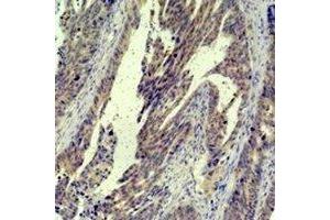 Immunohistochemical analysis of c-Jun staining in human breast cancer formalin fixed paraffin embedded tissue section. (C-JUN anticorps)