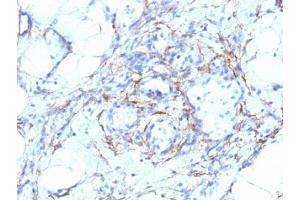 Formalin-fixed, paraffin-embedded human angiosarcoma stained with SMMHC antibody (MYH11/923 + SMMS-1). (MYH11 anticorps)