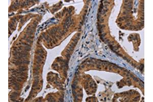 The image on the left is immunohistochemistry of paraffin-embedded Human gastric cancer tissue using ABIN7191352(MAGEB3 Antibody) at dilution 1/20, on the right is treated with synthetic peptide. (MAGEB3 anticorps)
