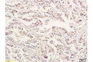Formalin-fixed and paraffin embedded human gastric carcinoma labeled with Anti-GPA33 Polyclonal Antibody, Unconjugated (ABIN673644) at 1:200 followed by conjugation to the secondary antibody and DAB staining. (GPA33 anticorps  (AA 151-280))