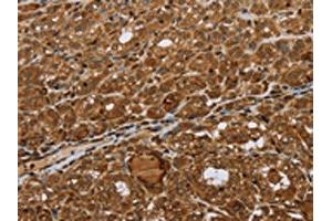 The image on the left is immunohistochemistry of paraffin-embedded Human thyroid cancer tissue using ABIN7192693(STMN2/STMN3/STMN4 Antibody) at dilution 1/45, on the right is treated with synthetic peptide. (STMN2 anticorps)