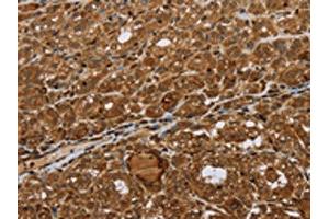 The image on the left is immunohistochemistry of paraffin-embedded Human thyroid cancer tissue using ABIN7192693(STMN2/STMN3/STMN4 Antibody) at dilution 1/45, on the right is treated with synthetic peptide. (STMN2/STMN3/STMN4 anticorps)