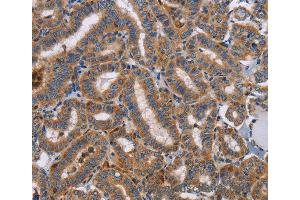 Immunohistochemistry of Human colon cancer using TLR8 Polyclonal Antibody at dilution of 1:40 (TLR8 anticorps)