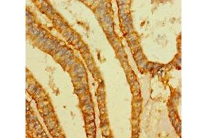 Immunohistochemistry of paraffin-embedded human endometrial cancer using ABIN7175511 at dilution of 1:100