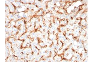 Formalin-fixed, paraffin-embedded human Hepatocellular Carcinoma stained with C1QB Mouse Monoclonal Antibody (C1QB/2965). (C1QB anticorps  (AA 41-188))