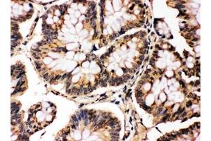 IHC testing of FFPE human intestinal cancer with MAPK8/9 antibody. (MAPK8 / MAPK9 (Middle Region) anticorps)