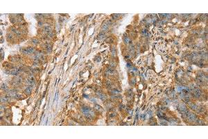 Immunohistochemistry of paraffin-embedded Human esophagus cancer tissue using SLC41A2 Polyclonal Antibody at dilution 1:45 (SLC41A2 anticorps)