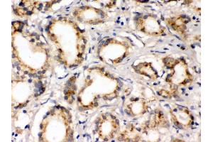 Anti- FXYZ1 Picoband antibody, IHC(P) IHC(P): Human Prostatic Cancer Tissue (FXYD1 anticorps  (AA 21-92))