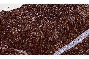 ABIN6276284 at 1/100 staining Human urothelial cancer tissue by IHC-P. (Perforin 1 anticorps  (N-Term))
