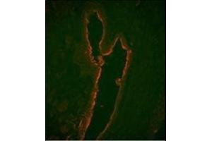 Immunofluorescence analysis of LTF Monoclonal Antibody with paraffin-embedded human prostate carcinoma tissue. (Lactoferrin anticorps)