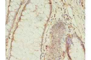 Immunohistochemistry of paraffin-embedded human colon cancer using ABIN7159399 at dilution of 1:100
