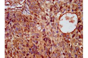 IHC image of ABIN7163983 diluted at 1:200 and staining in paraffin-embedded human cervical cancer performed on a Leica BondTM system. (Kcne3 anticorps  (AA 1-57))