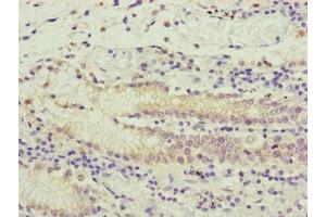 Immunohistochemistry of paraffin-embedded human gastric cancer using ABIN7166519 at dilution of 1:100