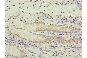 Immunohistochemistry of paraffin-embedded human gastric cancer using ABIN7166519 at dilution of 1:100 (PCDHA12 anticorps  (AA 862-941))