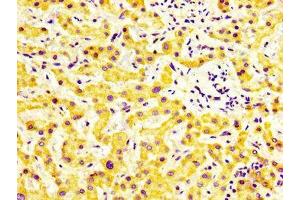 IHC image of ABIN7160609 diluted at 1:600 and staining in paraffin-embedded human liver cancer performed on a Leica BondTM system.