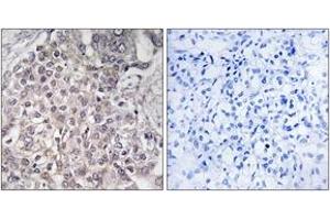 Immunohistochemistry analysis of paraffin-embedded human liver carcinoma, using Cytochrome P450 4F2 Antibody. (CYP4F2 anticorps  (AA 41-90))