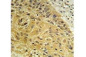 WNT5A antibody immunohistochemistry analysis in formalin fixed and paraffin embedded human lung carcinoma. (WNT5A anticorps  (AA 185-213))