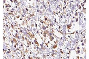 ABIN6279776 at 1/100 staining Human breast cancer tissue by IHC-P. (ARHGEF6 anticorps  (N-Term))