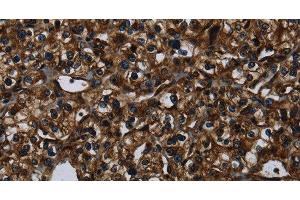 Immunohistochemistry of paraffin-embedded Human prostate cancer using KLK14 Polyclonal Antibody at dilution of 1:40