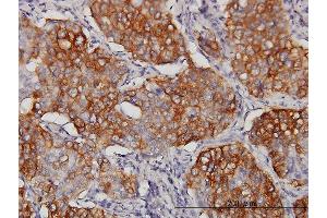 Immunoperoxidase of monoclonal antibody to EIF4G3 on formalin-fixed paraffin-embedded human lung, adenosquamous cell carcinoma. (EIF4G3 anticorps  (AA 1-515))