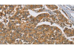 Immunohistochemistry of paraffin-embedded Human breast cancer tissue using ERK 3 Polyclonal Antibody at dilution 1:40 (MAPK6 anticorps)